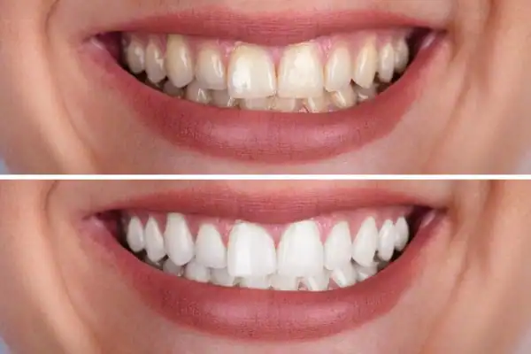 Blue Light Teeth Whitening Before and after results Andover